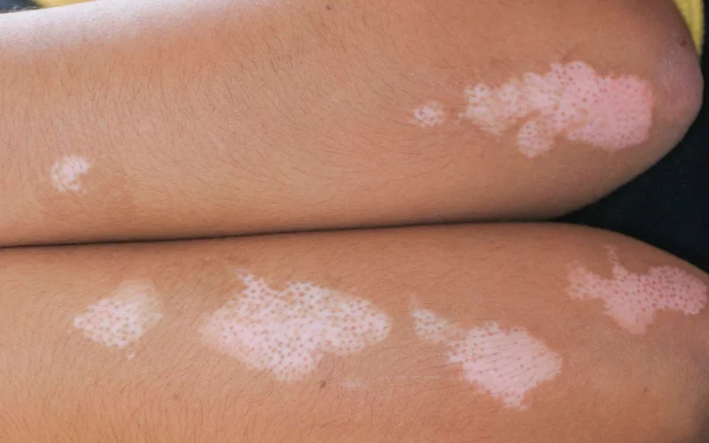causes-white-spots-on-the-skin