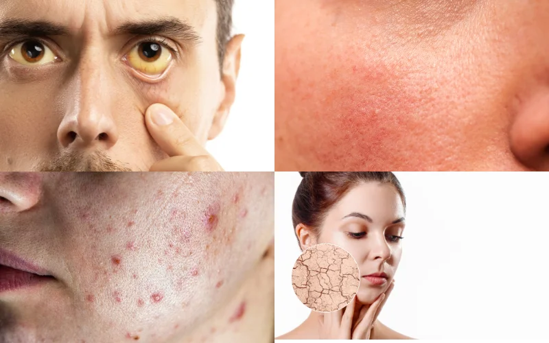 skin-signs-of-liver-damage